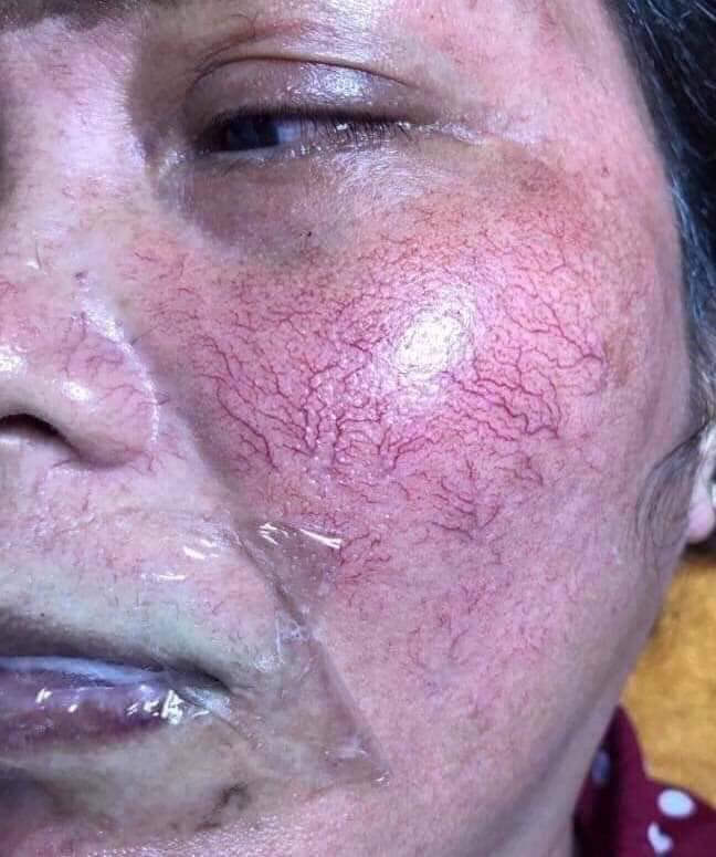 Vì Sao Ngưng Kem Trộn Da Xấu Hơn Trước?